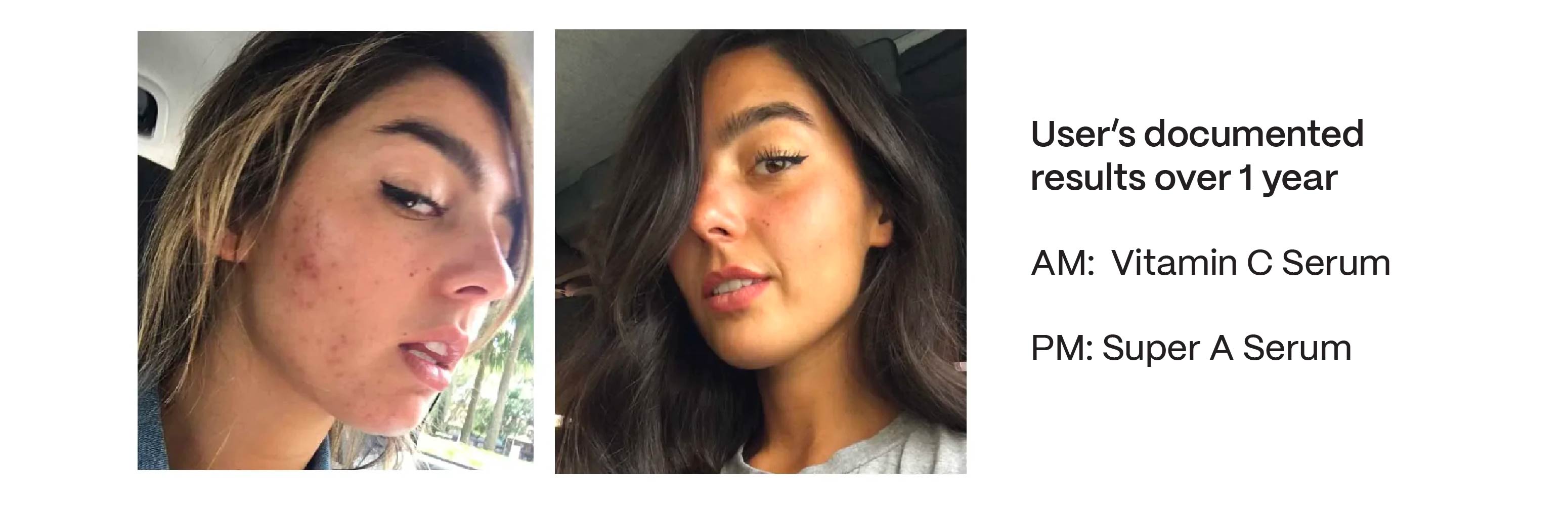 acne before and after 